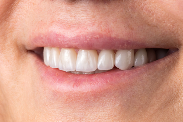 Is Dental Bonding An Option For Damaged Enamel?