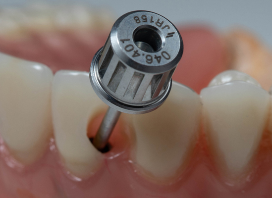 How Same Day Dental Implants Are Possible