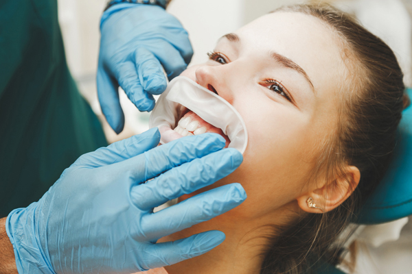 Guide To Professional Teeth Whitening Procedures